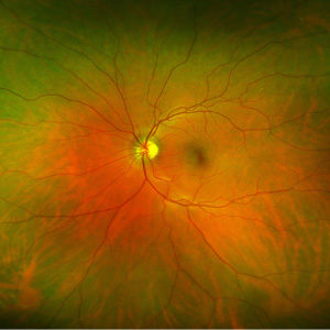 Optomap Retinal Image