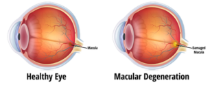 Eye Disease Macular Degeneration