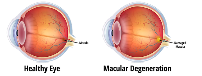 Macular Degeneration Testing, Eye Care